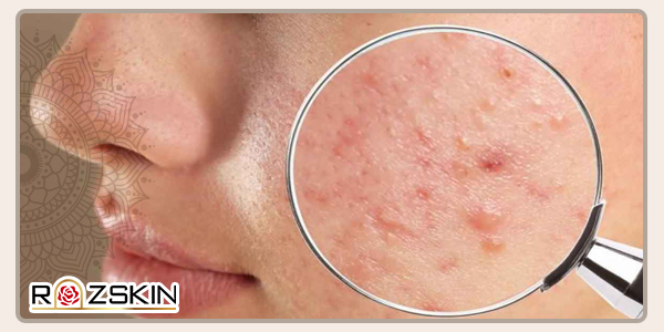 روش های مقابله با جوش های صورت