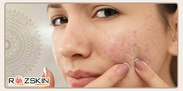 روتین پوست مناسب برای رفع جوش و آکنه